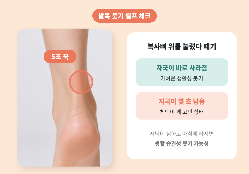 발목 붓기 셀프 체크 복사뼈 위 눌러보기