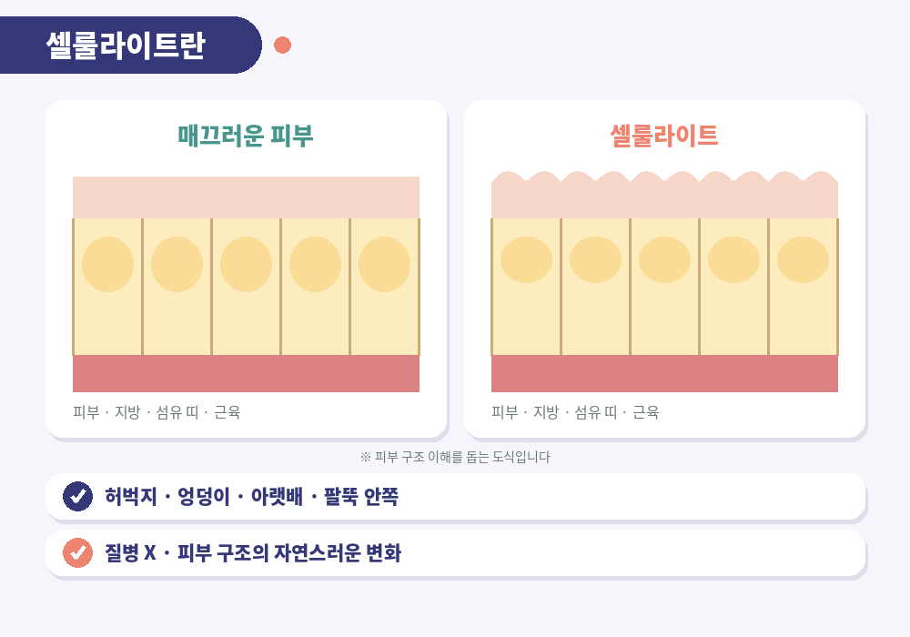 셀룰라이트란 피부 아래 지방 결합 조직 귤껍질 피부